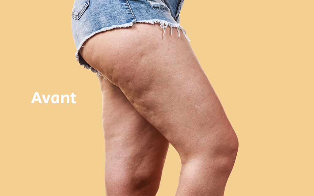 Cellulite avant mid